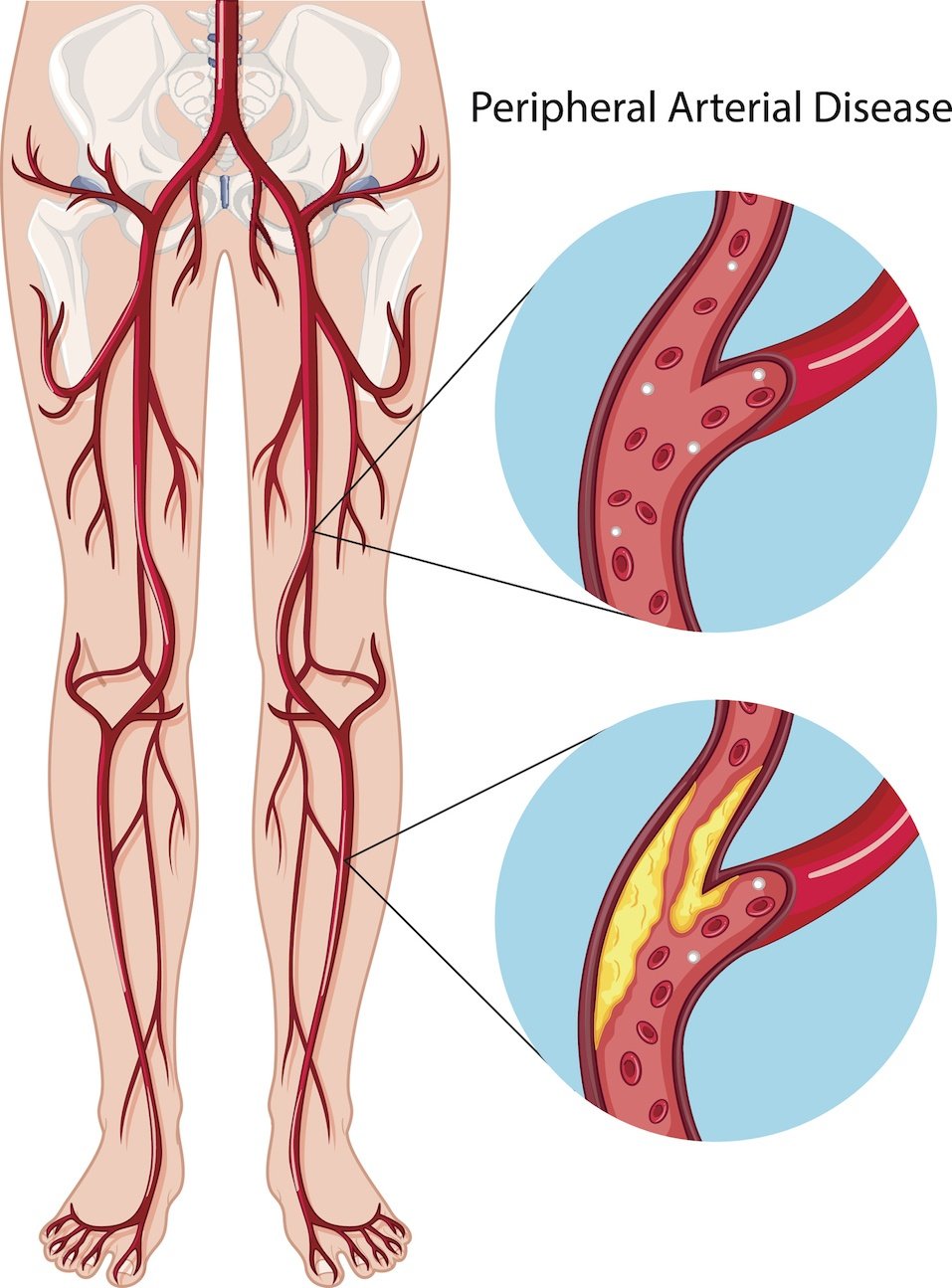 Horrible Things High Cholesterol Can Do to Your Body