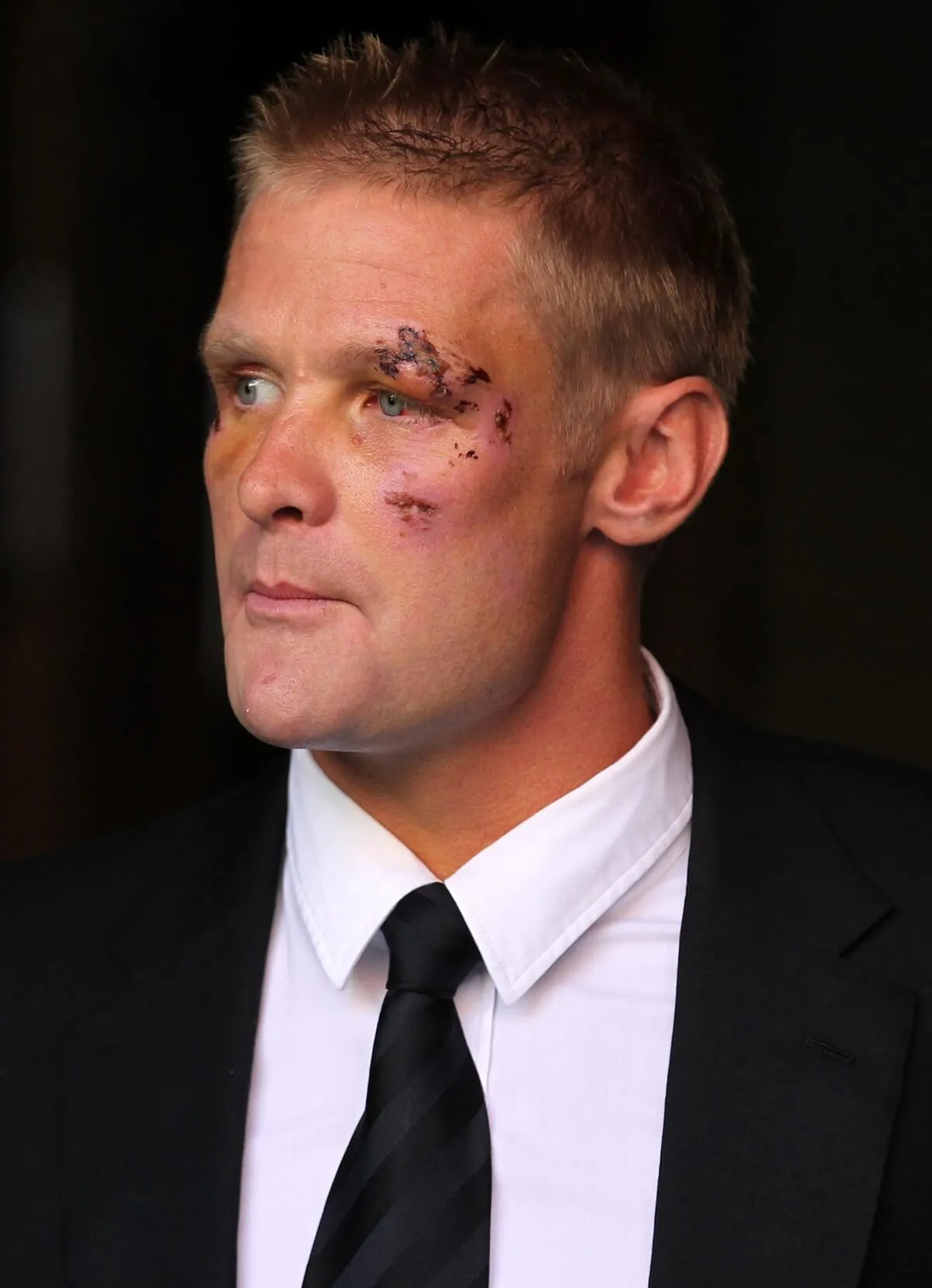 Mike Tindall's best man Iain Balshaw with a bruised face at a hotel in Edinburgh just before Mike's wedding to Zara